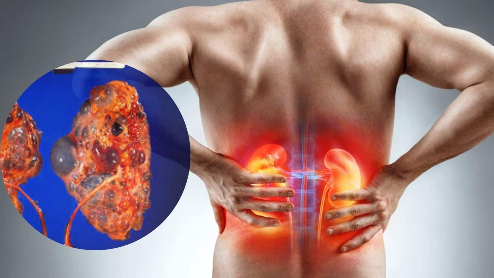 10 Symptoms Your Kidneys Are Completely Damaged